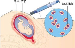高龄孕妇要重视羊水穿刺